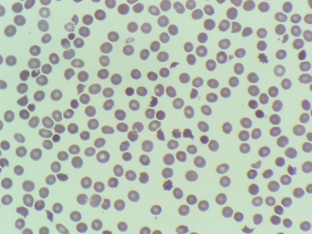 Blood film from the October 2026 case (MGG, ×100 oil)