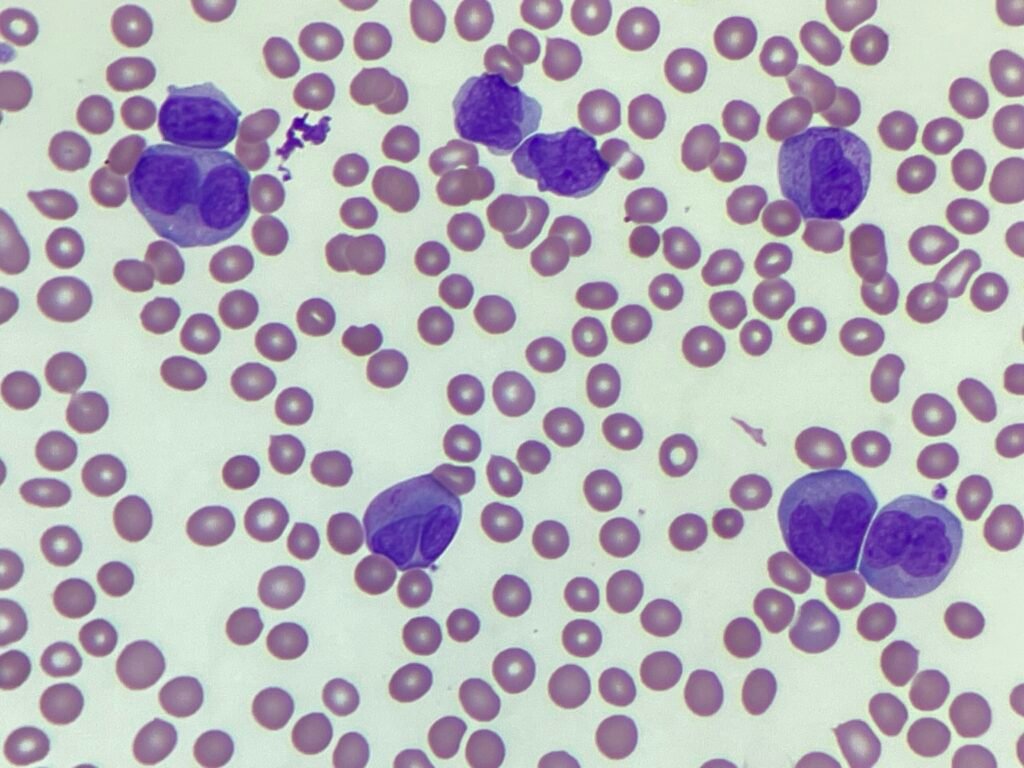 Image of peripheral blood showing bilobed cells seen in APML.
