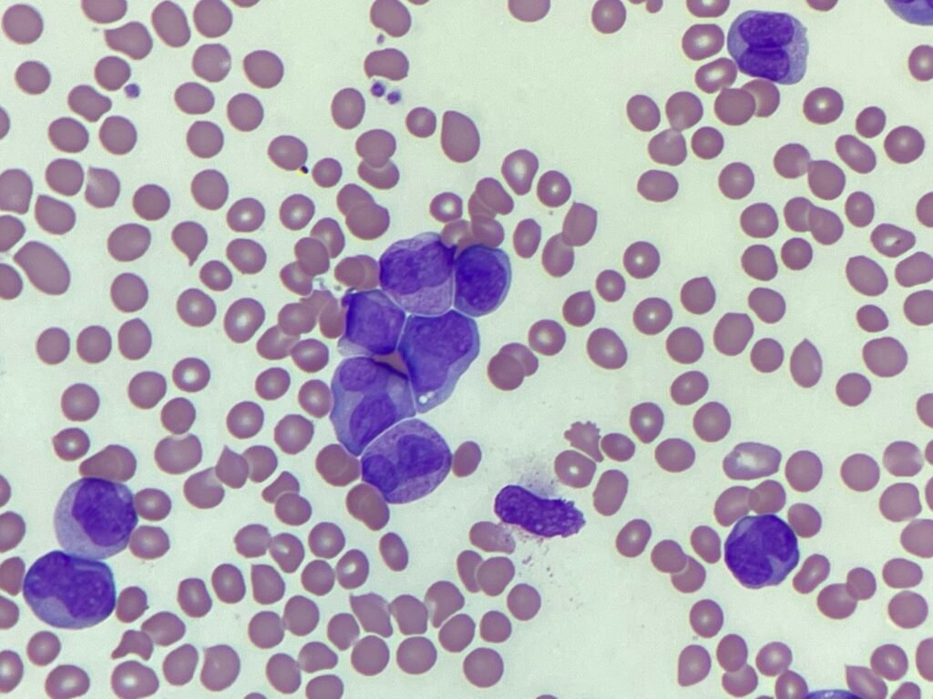 Image of peripheral blood showing bilobed cells seen in APML.