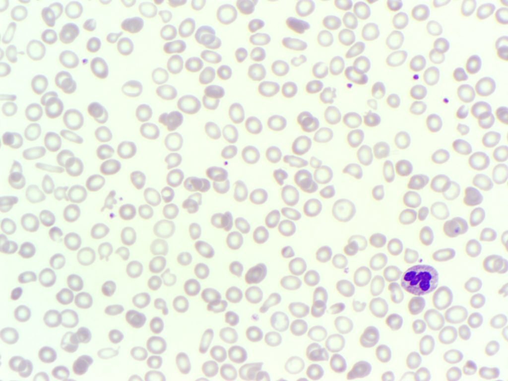 A blood film image from a patient with a PR bleed showing hypochromic cells