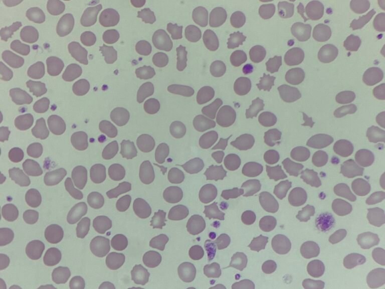MM250915: Renal impairment / IDA