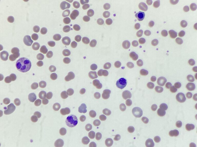 Haemolytic anaemia