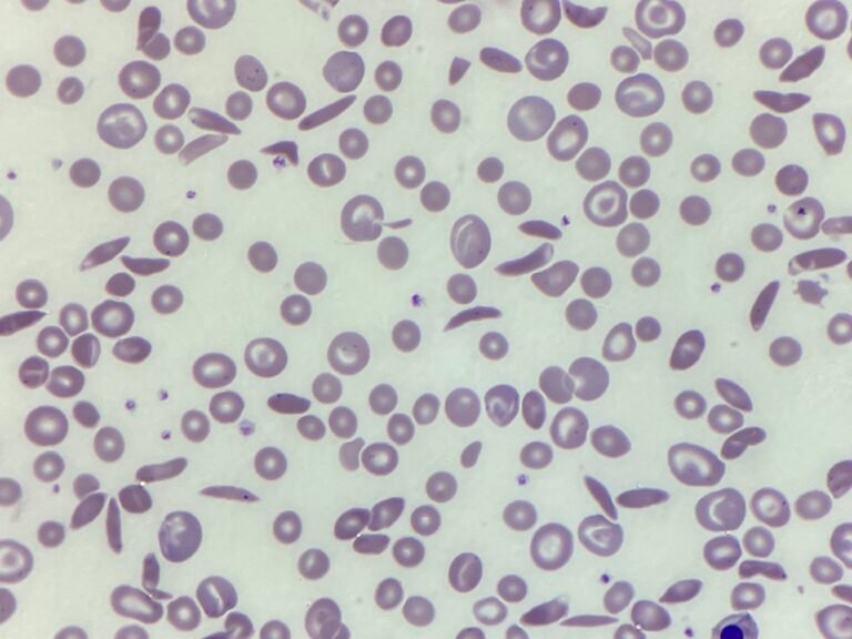 MM250728: Sickle cell disease