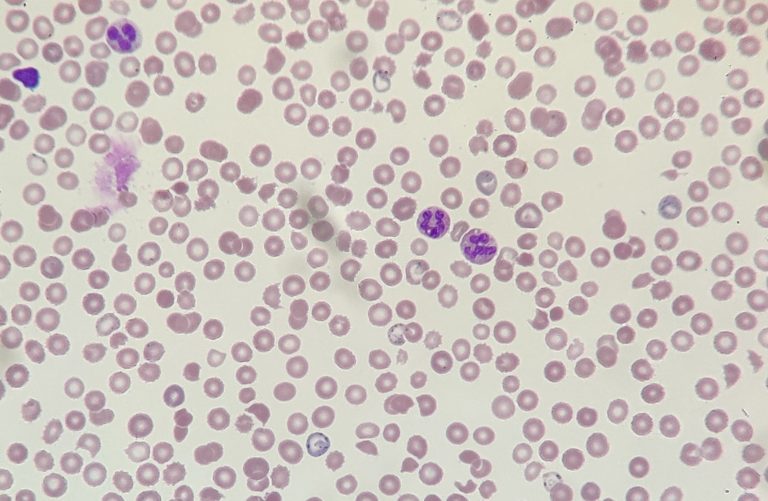 Basophilic stippling on a peripheral blood film from a patient with aplastic anaemia
