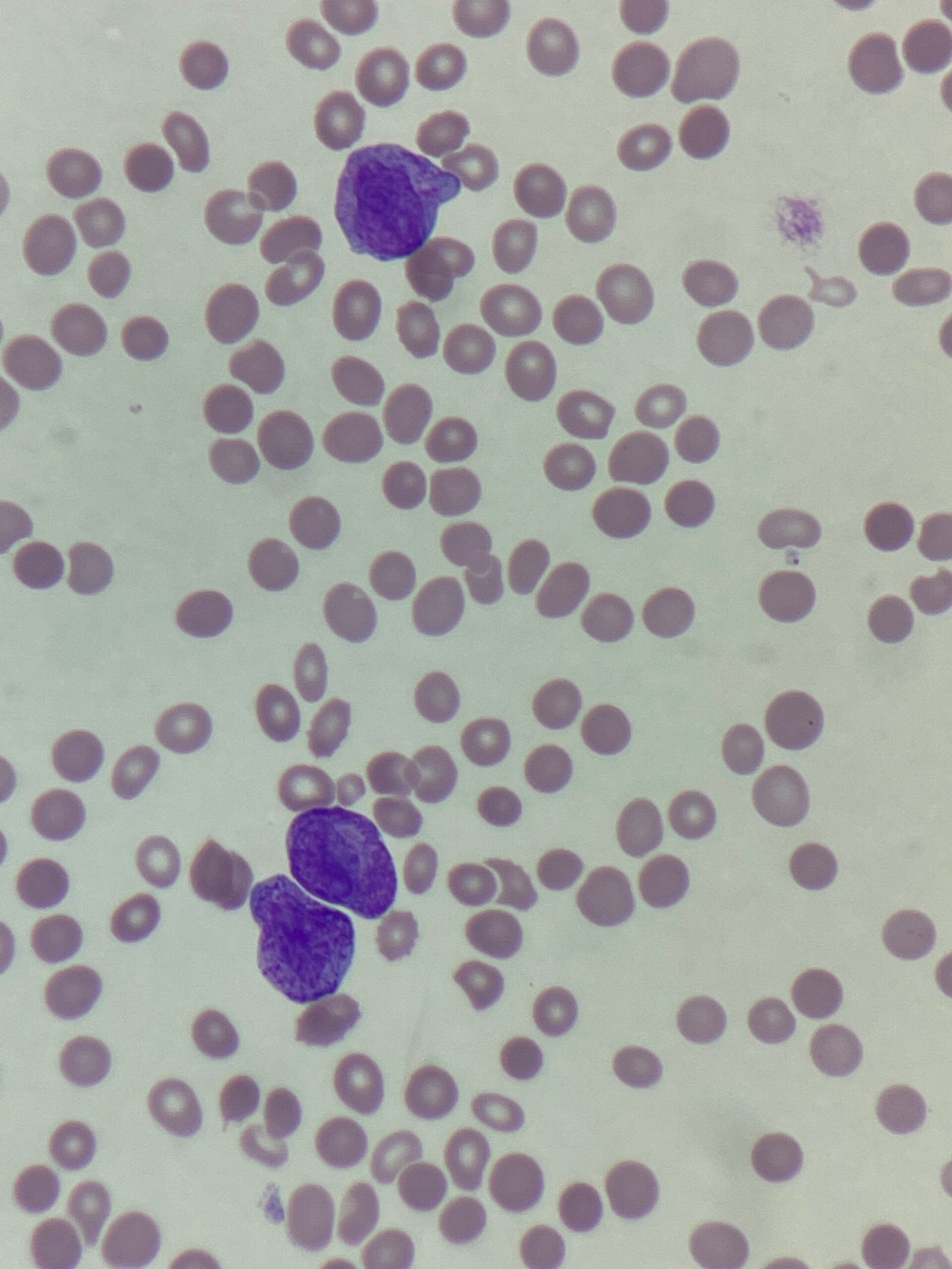 MM251013: Acute promyelocytic leukaemia (APML)