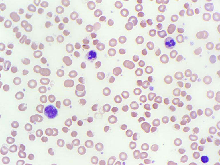 Peripheral blood film showing blister cells in a patient with G6PD deficiency
