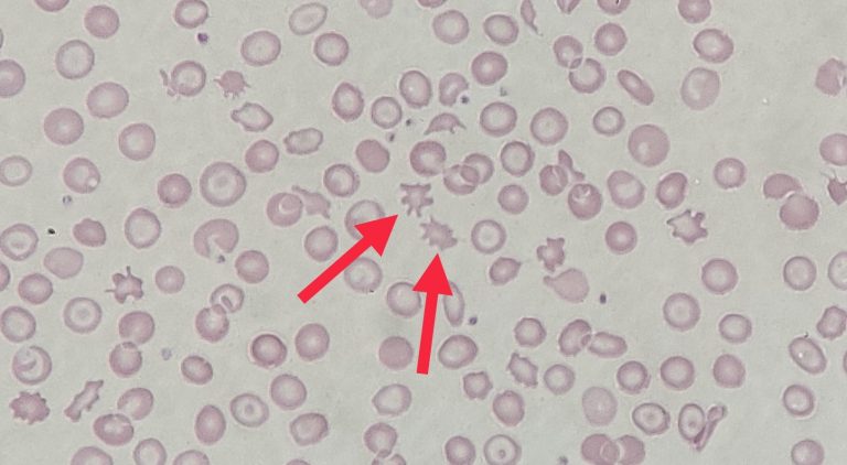 Peripheral blood film image showing acanthocytes
