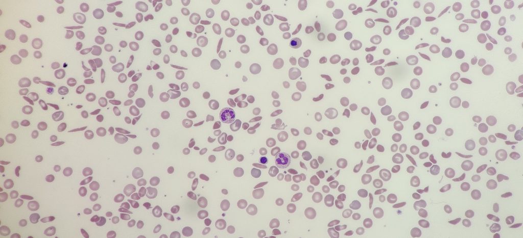 Peripheral blood film showing spherocytes in a patient with SCD