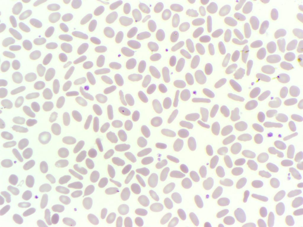 elliptocytes