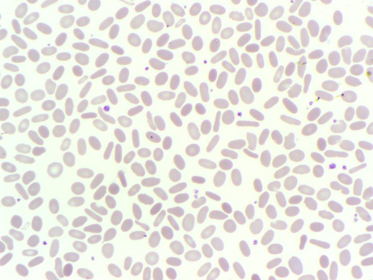 Peripheral blood film showing elliptocytes in a patient with a hereditary elliptocytosis