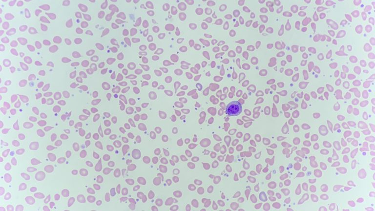 Dacrocytes (tear drop cells) on a blood film from a patient with myelofibrosis