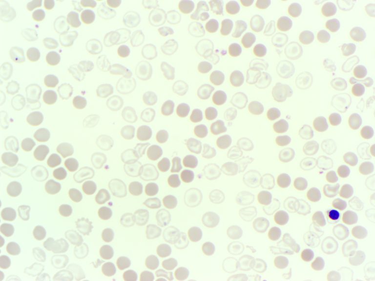 A blood film image from a patient with Beta thalasseamia, showing dimorphic red cells