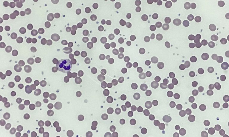 Peripheral blood film showing spherocytes in a patient with HS