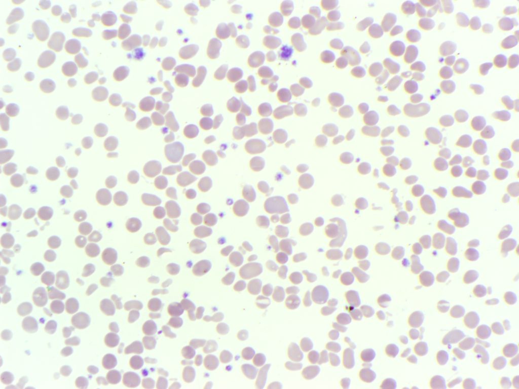 Peripheral blood film showing spherocytes in a patient with pyropoikilocytosis