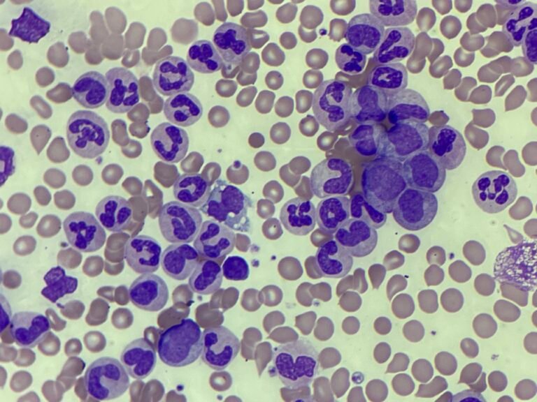 MM250609: Chronic myeloid leukaemia (CML)