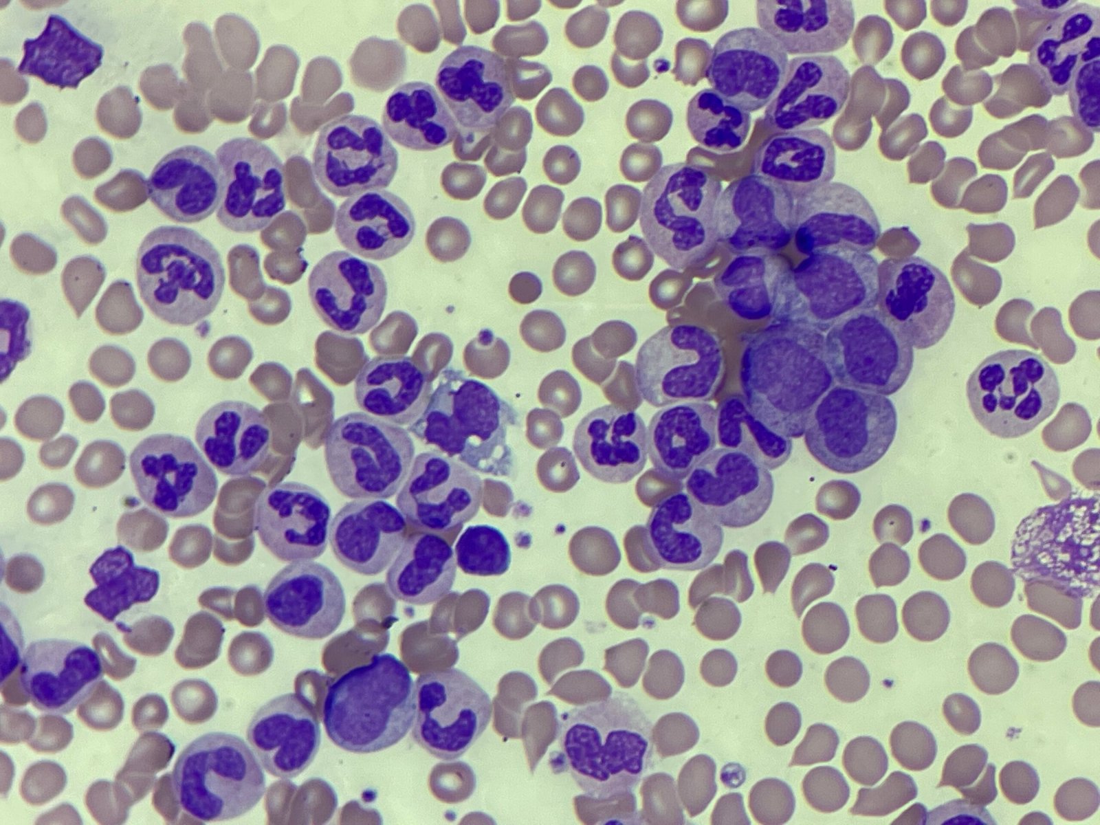 81 year old presents with increased white cell count,