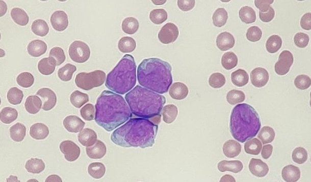 Increased adhesion of blast cells in acute myeloid leukaemia