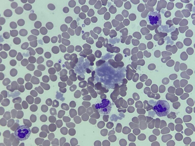Cryoglobulins-1