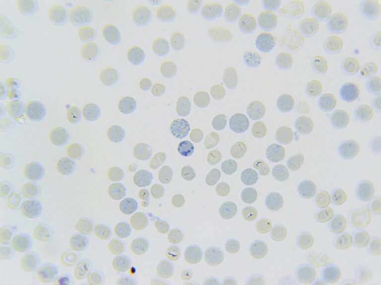 MM250915: Haemoglobin H disease