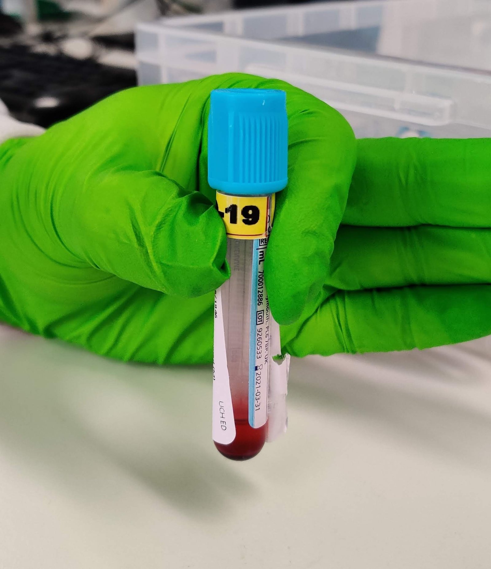 An underfilled citrate sample.